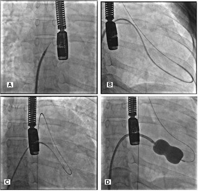 Revisiting percutaneous balloon mitral valvotomy technique and safety in various population: an evidence-based case report and literature review